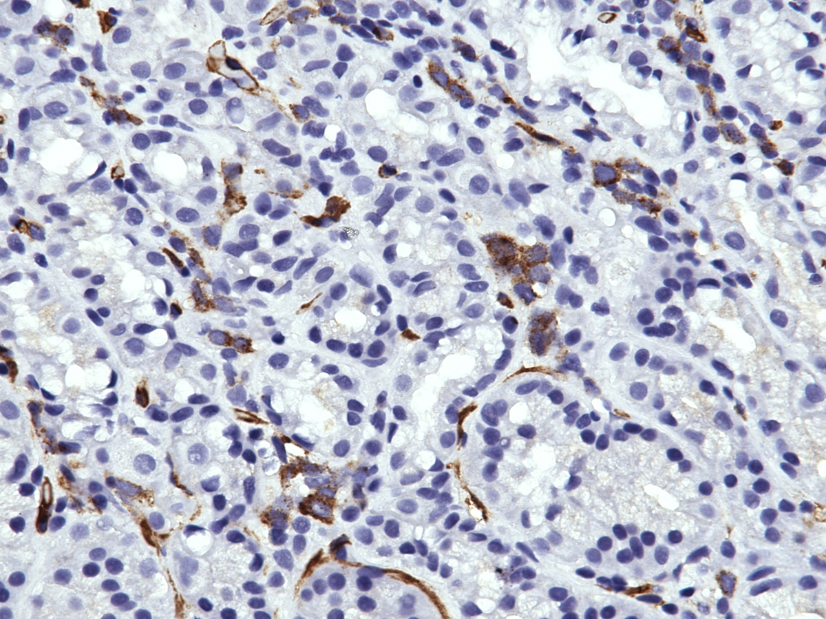 gastric erosion, CD34, 40x, demonstrating clusters of CD34 positive cells